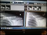 WTB Left Clavicle-titanium-jpg